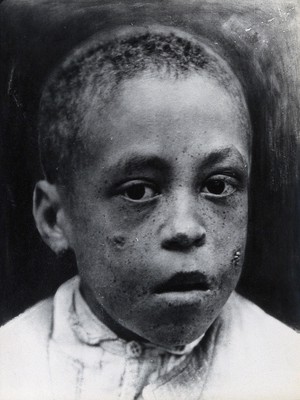 view Leprosy: nodules on a boy's face: a head and shoulders portrait. Photograph, 1870/1910.