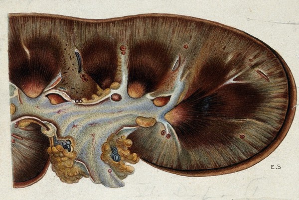 Yellow fever: section of a kidney of a patient infected with yellow fever. Watercolour, 1900/1930 (?).