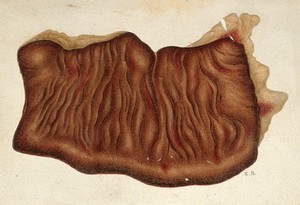 view Yellow fever: section of the large intestine of a patient infected with yellow fever. Watercolour, 1900/1930 (?).