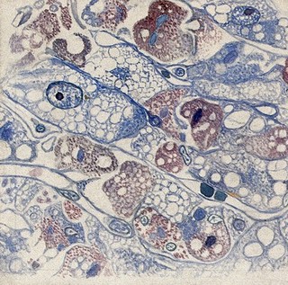 Yellow fever: section of the liver of a patient infected with yellow fever. Watercolour, ca. 1920.