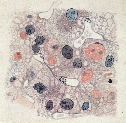 Yellow fever: section of the liver of a patient infected with yellow fever. Watercolour, ca. 1920.