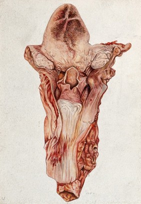 Yellow fever: organs of the mouth and neck of a patient infected with yellow fever. Watercolour, 1930/1950 (?), after a drawing (?) by Amadeu Fialho, 1929.