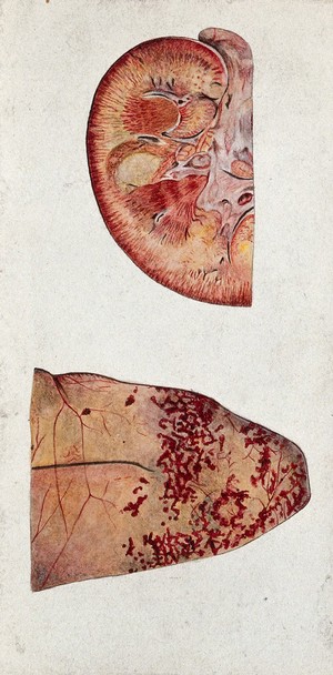 view Yellow fever: sections of the kidney and liver of patients infected with yellow fever. Watercolour, 1930/1950 (?), after a drawing (?) by Amadeu Fialho, 1929.