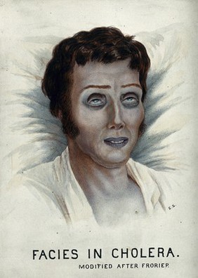 A cholera victim with a typical facial appearance. Watercolour by E. Schwarz, 1920/1950 (?), after Robert Froriep, ca. 1831.