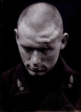 Cranio-facial injury: a French soldier with an injury to his forehead, shown from the front before plastic surgery. Photograph, 1917.