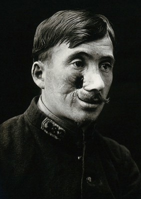 Cranio-facial injury: a French soldier with an injury to the right cheek, side view before plastic surgery. Photograph, 1916.