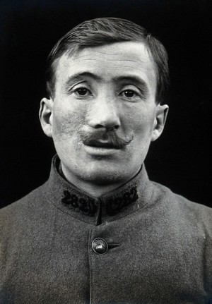 view Cranio-facial injury: a French soldier with an injury to the right cheek, front view after plastic surgery. Photograph, 1917.