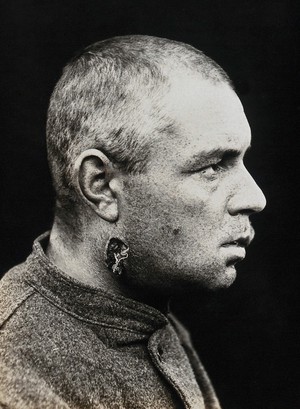 view Cranio-facial injury: a French soldier with an injury to the neck, in profile: before plastic surgery. Photograph, 1918.