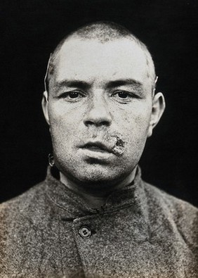 Cranio-facial injury: a French soldier with an injury by his mouth: before plastic surgery. Photograph, 1918.