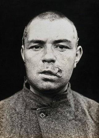 Cranio-facial injury: a French soldier with an injury by his mouth: before plastic surgery. Photograph, 1918.