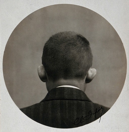 Cosmetic surgery: the back of a man's head, showing his fleshy ears: before surgery. Photograph, 1909 (?).