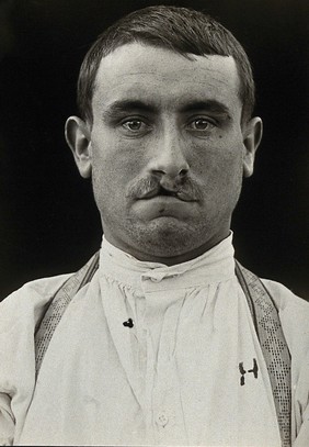 Cleft palate: head and shoulders portrait of a man with a cleft palate. Photograph, 1917.