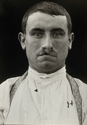 view Cleft palate: head and shoulders portrait of a man with a cleft palate. Photograph, 1917.