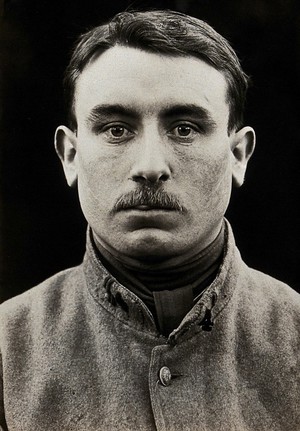 view Cleft palate: a man after corrective surgery: head and shoulders portrait. Photograph, 1918.