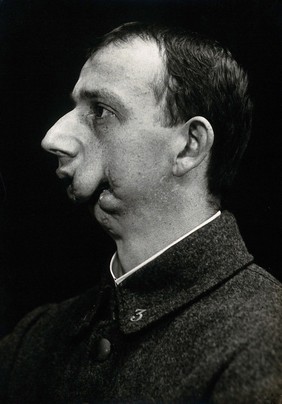 Cranio-facial injury: a French soldier with injuries to the mouth and chin, in profile: before plastic surgery. Photograph, 1916.