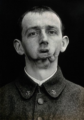 Cranio-facial injury: a French soldier with injuries to the mouth and chin: after plastic surgery. Photograph, 1916.