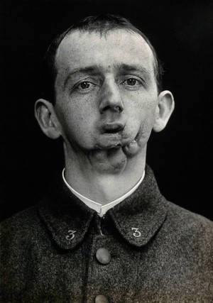 view Cranio-facial injury: a French soldier with injuries to the mouth and chin: after plastic surgery. Photograph, 1916.