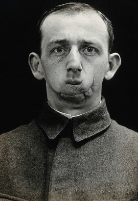 Cranio-facial injury: a French soldier with injuries to the mouth and chin, showing scarring after plastic surgery. Photograph, 1916.