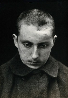 Cranio-facial injury: a French soldier with a head injury: before plastic surgery. Photograph, 1916.