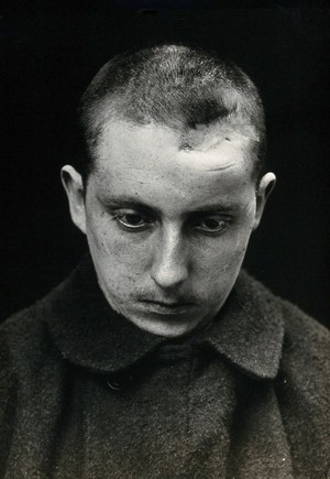 view Cranio-facial injury: a French soldier with a head injury: before plastic surgery. Photograph, 1916.