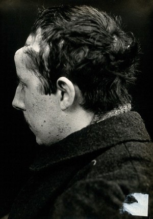 view Cranio-facial injury: a French soldier with a head injury, in profile: before plastic surgery. Photograph, 1916.