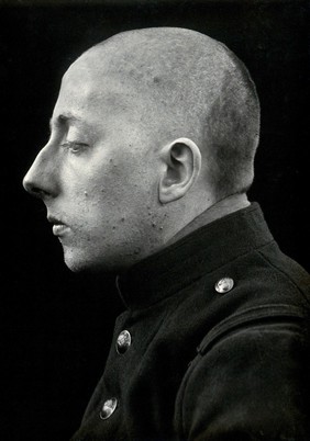 Cranio-facial injury: a French soldier with a head injury, after plastic surgery: in profile. Photograph, 1916.