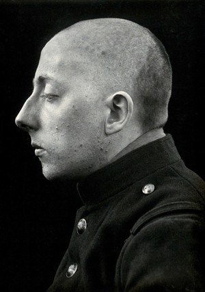 view Cranio-facial injury: a French soldier with a head injury, after plastic surgery: in profile. Photograph, 1916.