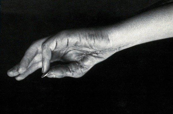 A hand holding a coin, showing scarring after corrective surgery. Photograph, ca. 1912.