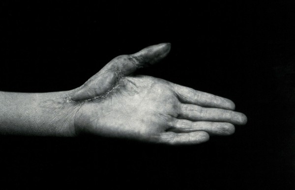 A hand, outstretched, showing scarring after corrective surgery. Photograph, ca. 1912.