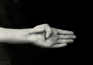 view A hand with a bent thumb, before corrective surgery. Photograph, ca. 1912.