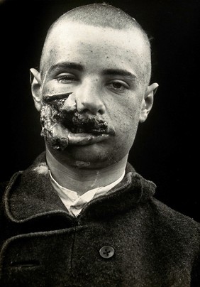 Cranio-facial injury: a French soldier with a wounded mouth and cheek: before plastic surgery. Photograph, 1917.