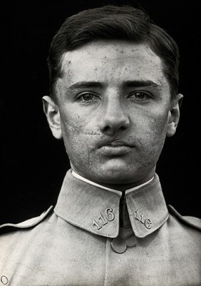 Cranio-facial injury: a French soldier with a wounded mouth and cheek, showing scarring after plastic surgery. Photograph, 1918.