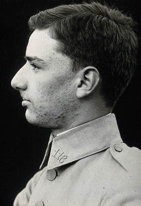 Cranio-facial injury: a French soldier with a wounded mouth and cheek, showing minimal scarring after plastic surgery, in profile. Photograph, 1918.