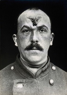 Cranio-facial injury: a French soldier with a wounded forehead, after some plastic surgery. Photograph, 1916.