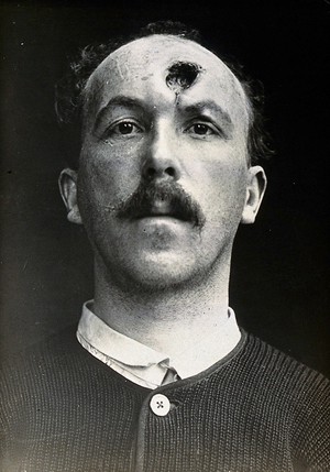 view Cranio-facial injury: a French soldier with a wounded forehead, before plastic surgery. Photograph, 1915.