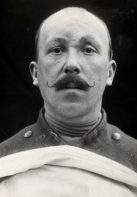 Cranio-facial injury: a French soldier with minimal scarring to his forehead after plastic surgery. Photograph, 1916.
