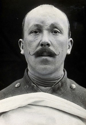 view Cranio-facial injury: a French soldier with minimal scarring to his forehead after plastic surgery. Photograph, 1916.