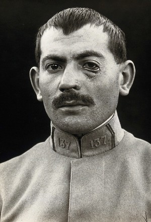 view Cranio-facial injury: a French soldier with a wounded eye, before plastic surgery. Photograph, 1916.