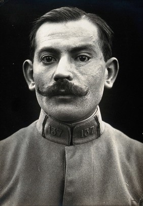 Cranio-facial injury: a French soldier with scarring around his eye, after plastic surgery. Photograph, 1916.