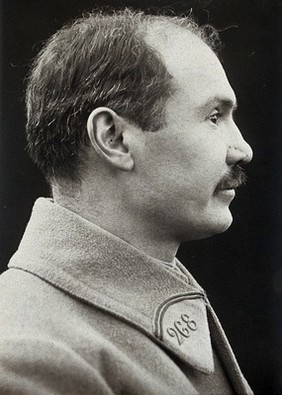 Cranio-facial injury: a French soldier with scarring to his nose, after plastic surgery: in profile. Photograph, 1918.