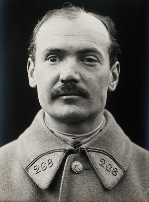 view Cranio-facial injury: a French soldier with minimal scarring to his nose, after plastic surgery. Photograph, 1918.