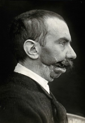 view Cranio-facial injury: a French soldier with a wounded mouth, before plastic surgery: in profile. Photograph, 1915.