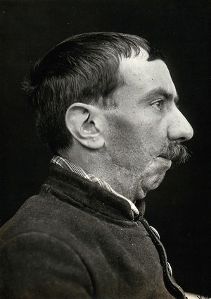 view Cranio-facial injury: a French soldier with scarring to the mouth following plastic surgery: in profile. Photograph, 1916.