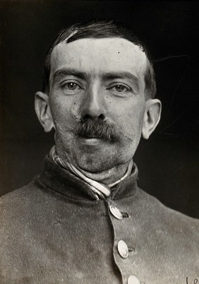 Cranio-facial injury: a French soldier with scarring to the mouth following plastic surgery. Photograph, 1916.