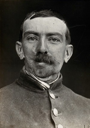 view Cranio-facial injury: a French soldier with scarring to the mouth following plastic surgery. Photograph, 1916.