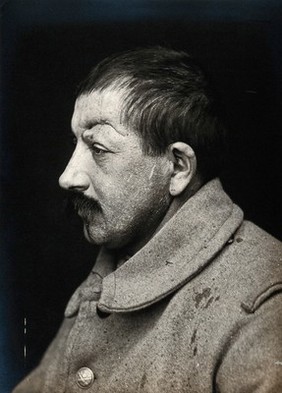 Cranio-facial injury: a French soldier with a scarred forehead, before plastic surgery at the Val-de-Grace hospital, Paris. Photograph, 1915.