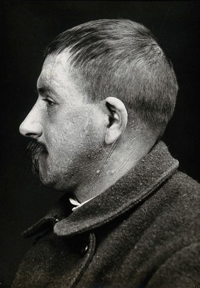 Cranio-facial injury: a French soldier with a scarred forehead following plastic surgery: in profile. Photograph, 1916.