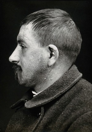 view Cranio-facial injury: a French soldier with a scarred forehead following plastic surgery: in profile. Photograph, 1916.