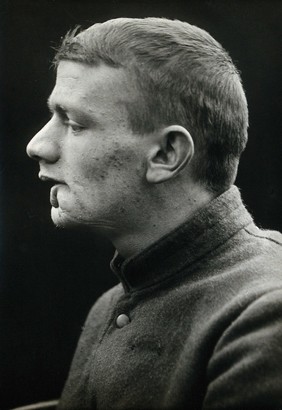 Cranio-facial injury: a man with a malformed lower lip, in profile, before plastic surgery. Photograph, 1912.