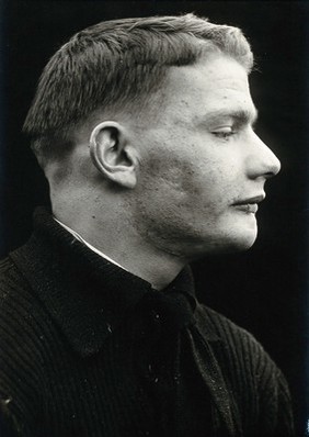 Cranio-facial injury: a man with a scarred lower lip following plastic surgery: in profile. Photograph, 1912.